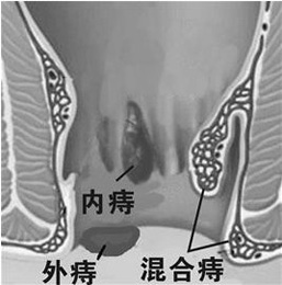 外痔應該怎么治療好