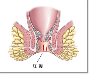 肛裂不治療會好嗎